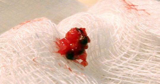 O echipă de doctori a găsit sub pielea unui bărbat un "implant extraterestru" atât de tare, încât acesta nu putea fi tăiat nici cu diamantul!