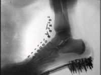 Razele X au fost inventate prima dată de Nikola Tesla şi nu de fizicianul german Röntgen!? Iată imaginea cu raze X a piciorului şi pantofului lui Tesla...