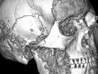 Cercetătorii au descoperit o intervenție chirurgicală avansată din epoca fierului, efectuată în urmă cu 2.500 de ani